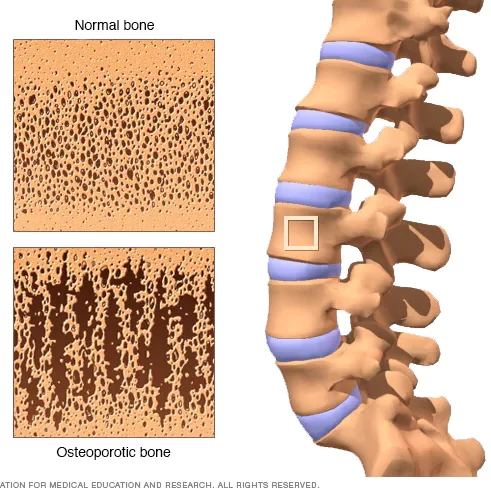 ds00128_im02980_mcdc7_osteoporosis-_comparethu_jpg