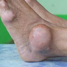 patient-gout-ankle