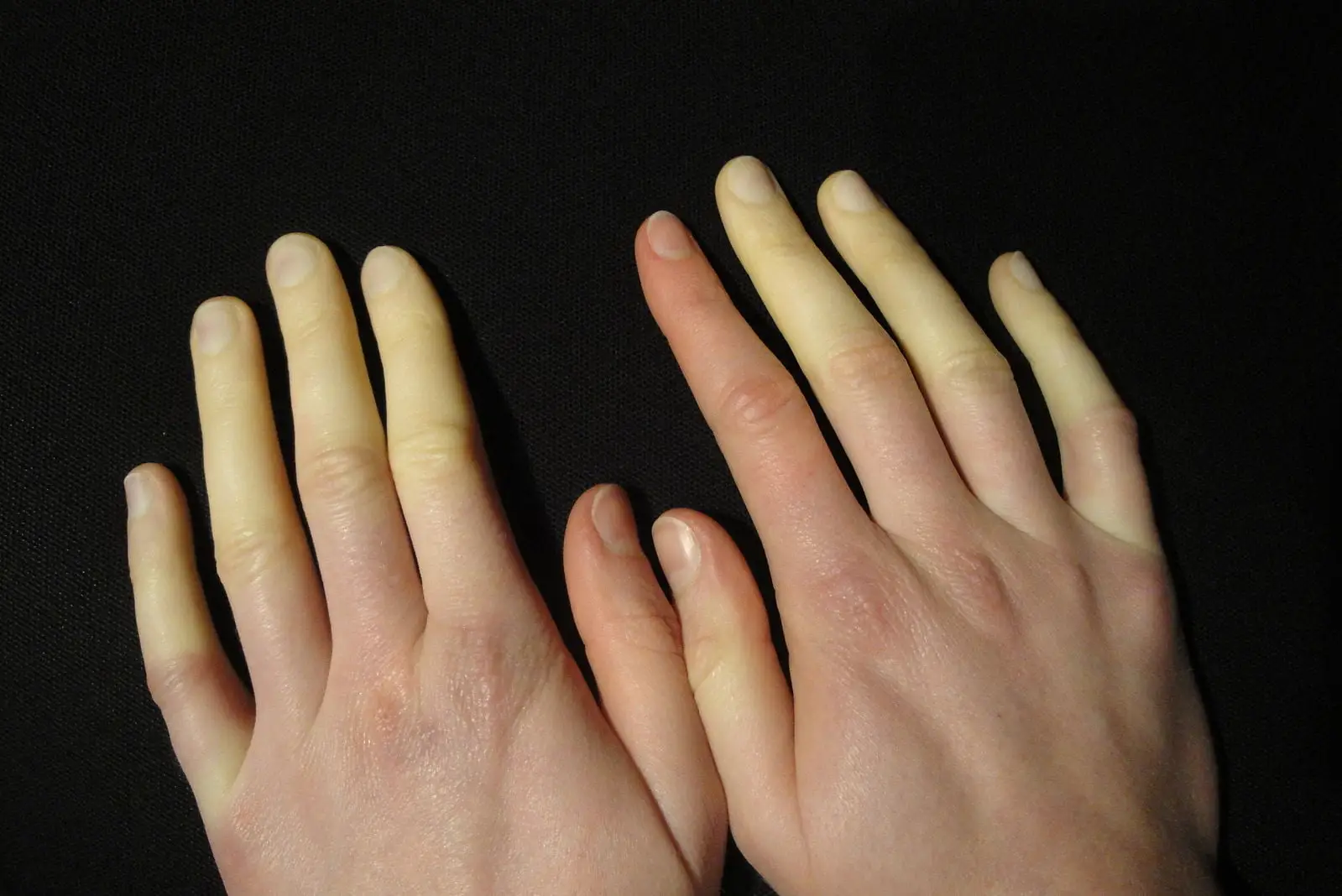 Raynaud’s Disease & Syndrome: Symptoms, Causes, Treatment