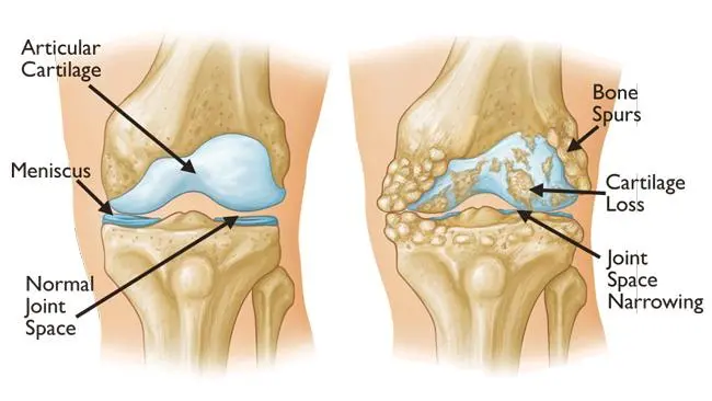 Osteoarthritis (OA) | Causes, symptoms, treatments