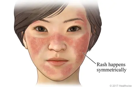 Lupus: Symptoms, Causes, Types & Treatments.