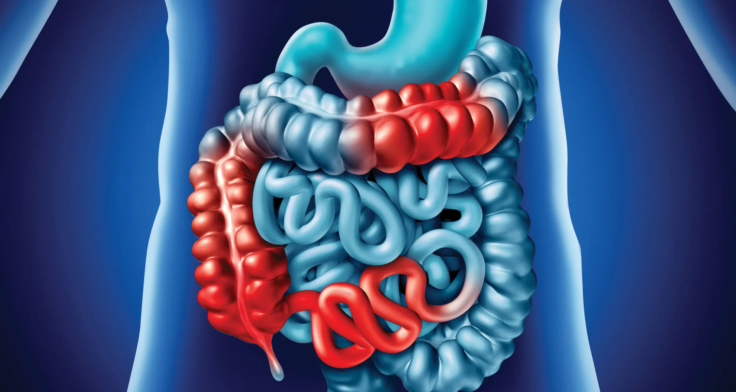 Crohn’s disease: Symptoms, diet, causes, diagnosis, and more
