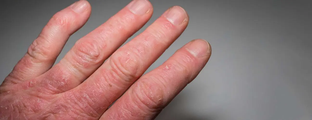 Psoriatic arthritis | Causes, symptoms, treatments