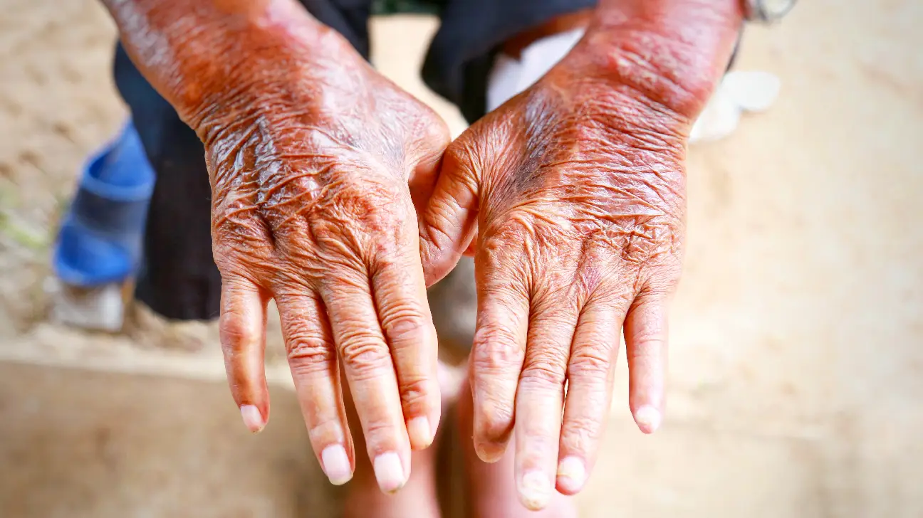 Scleroderma: Definition, Types, Symptoms, Causes