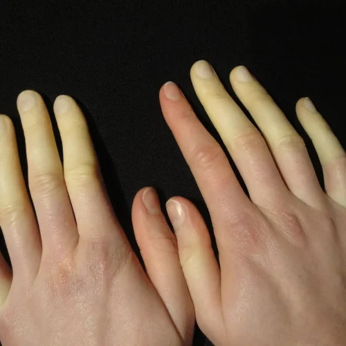 Raynaud’s Disease & Syndrome: Symptoms, Causes, Treatment