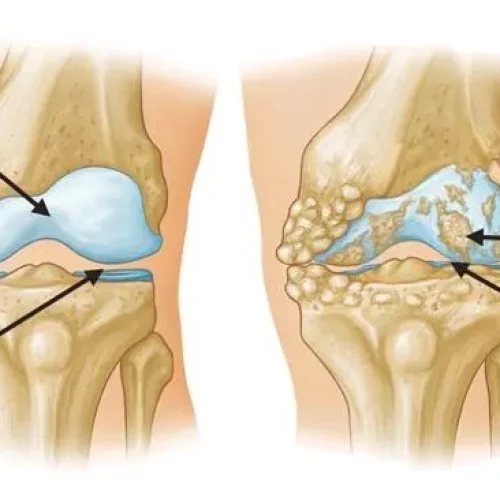 Osteoarthritis (OA) | Causes, symptoms, treatments