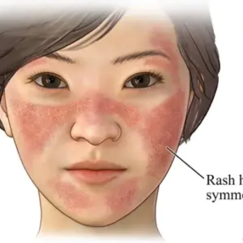 Lupus: Symptoms, Causes, Types & Treatments.