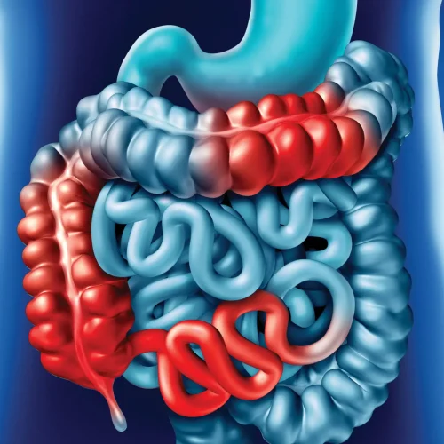 Crohn’s disease: Symptoms, diet, causes, diagnosis, and more