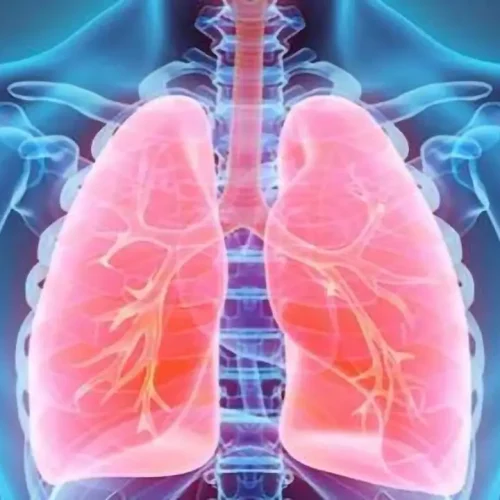 Sarcoidosis: Causes, Symptoms & Treatment