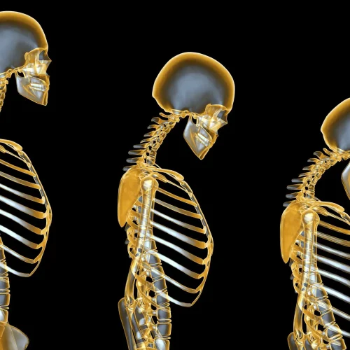 Osteoporosis: Symptoms, Causes, Tests & Treatment