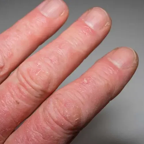 Psoriatic arthritis | Causes, symptoms, treatments