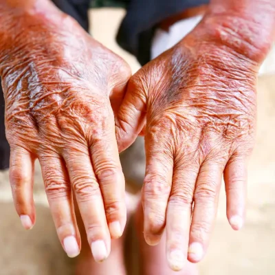 Scleroderma: Definition, Types, Symptoms, Causes