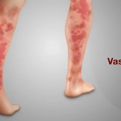 Vasculitis: Treatment, symptoms, causes, and types.